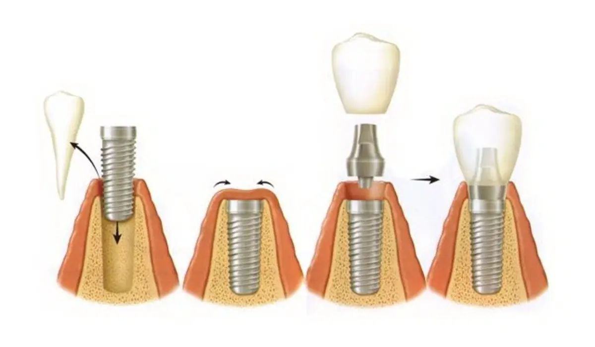 Understanding the Dental Implant Procedure Experience