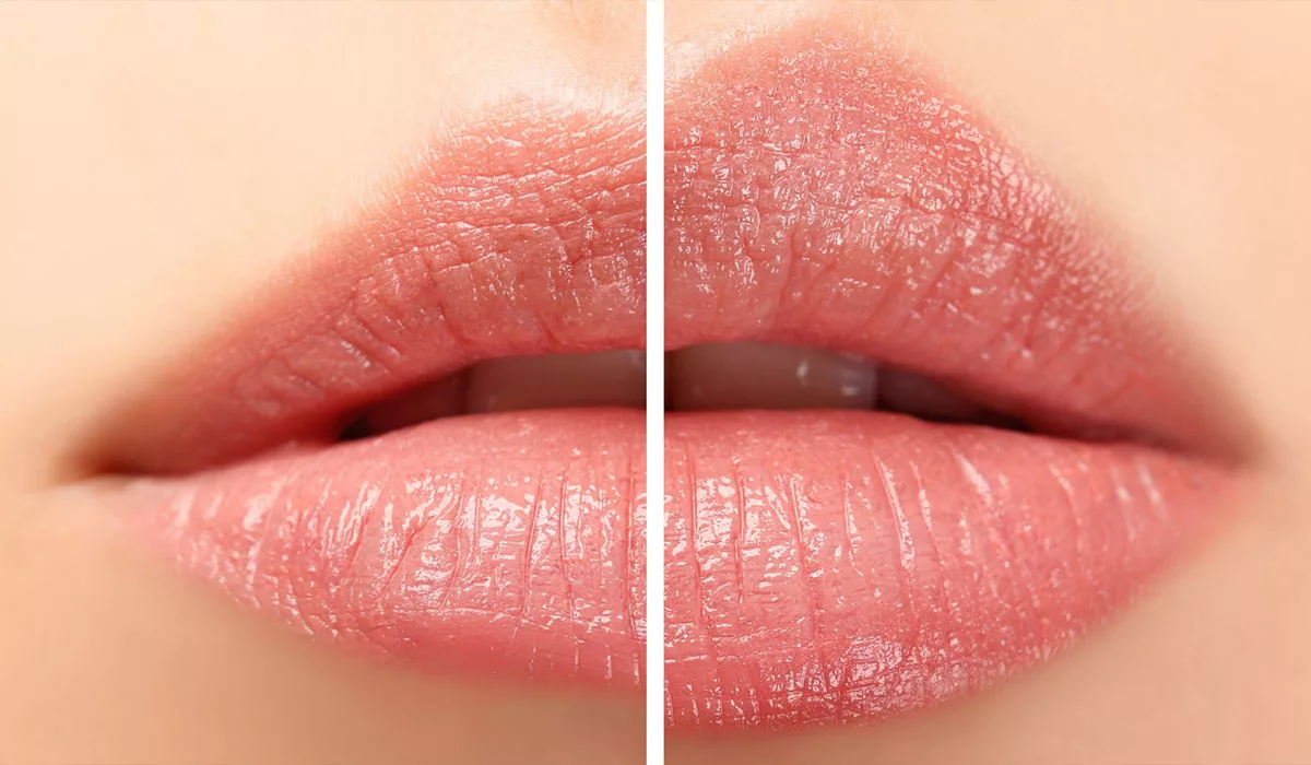 Preparing for Your Lip Filler Treatment