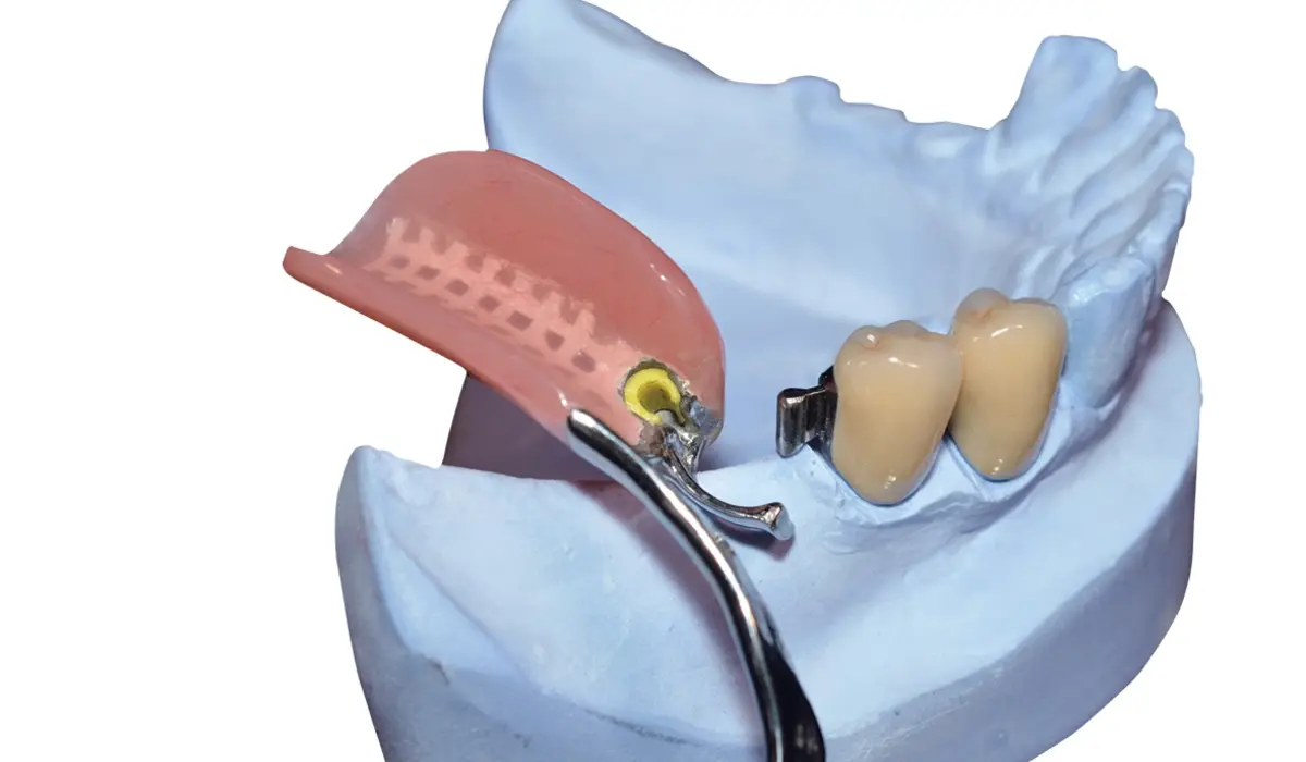 4. Final Prosthetic Attachment