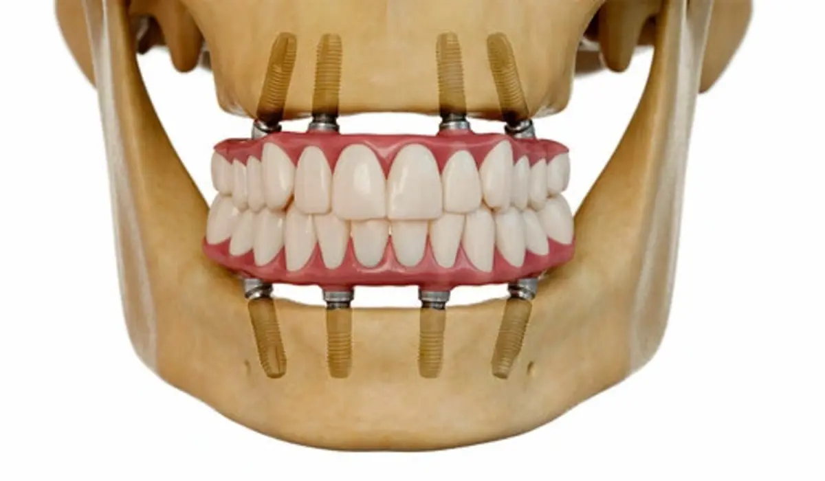 What Are All-on-4 Dental Implants?