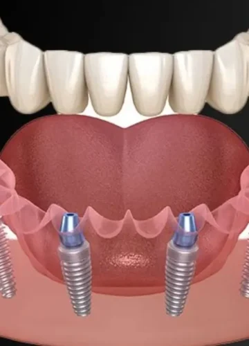 All on 4 Dental Implants