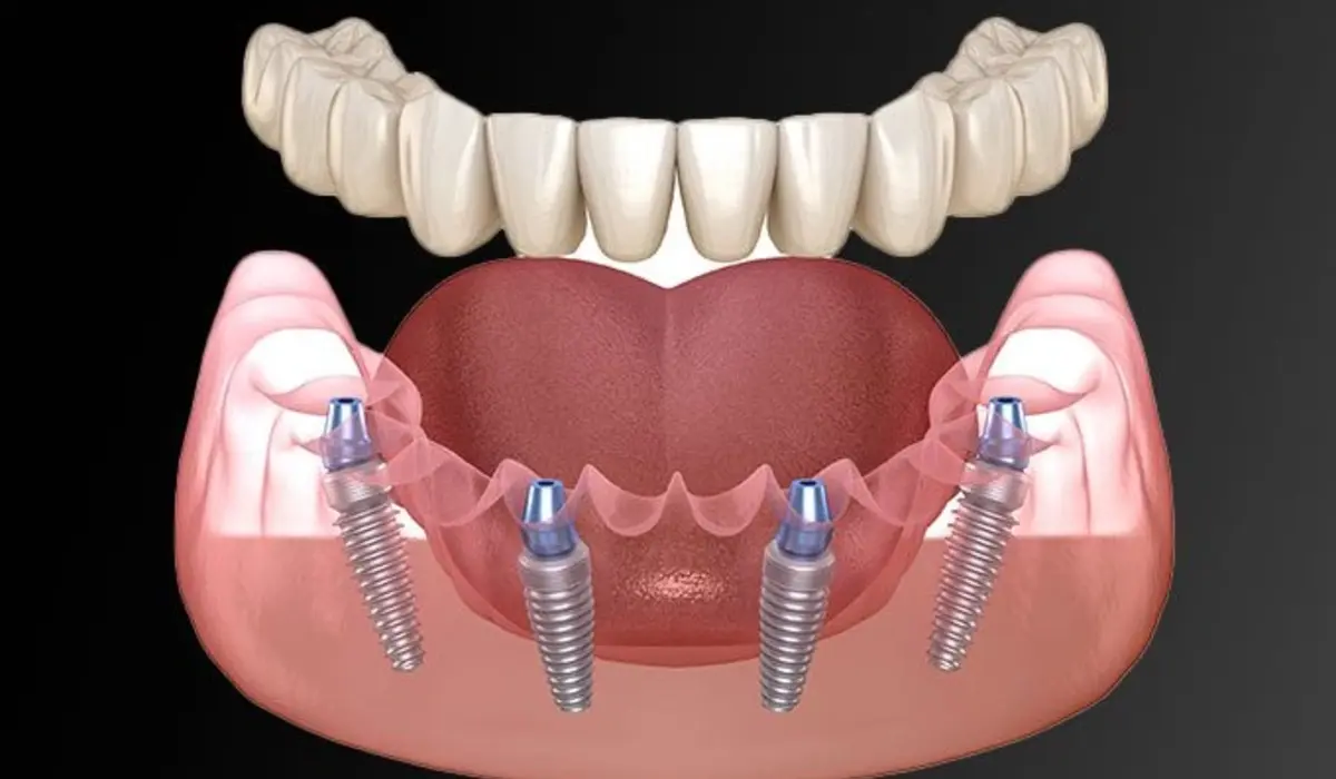 All on 4 Dental Implants