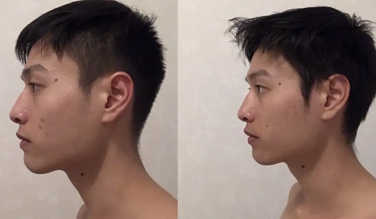 How It Compares to Other Jawline Trends