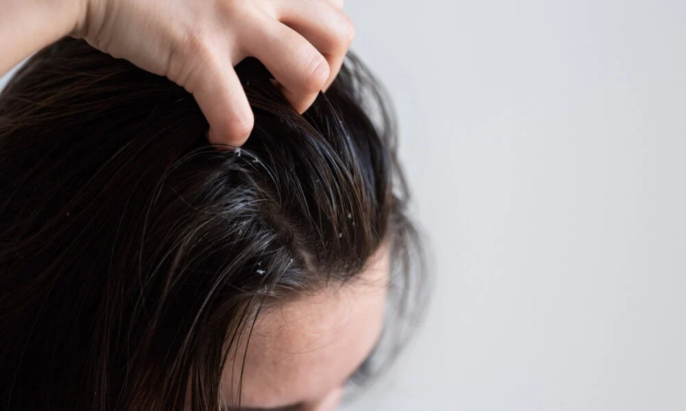 A close-up of a hand parting dark hair to reveal the scalp, suggesting someone checking for flakes or irritation in a calm, clinical setting.